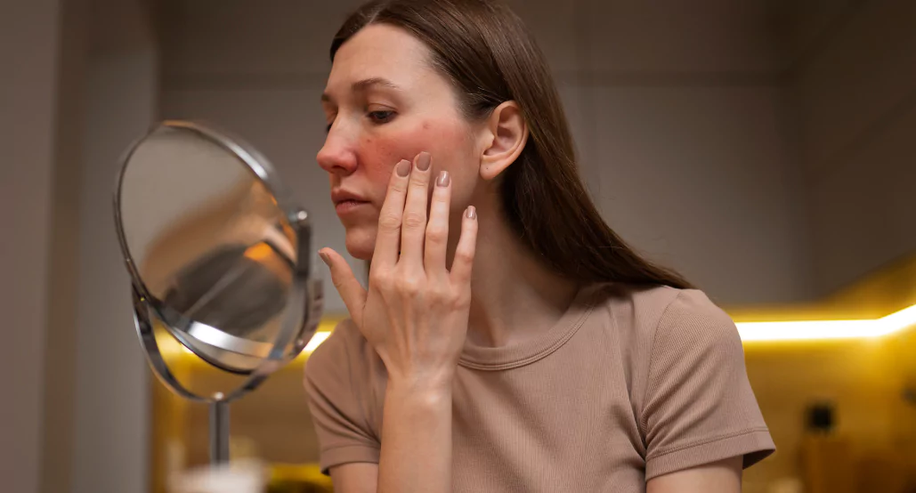 Does Alcohol Cause Eczema Flare Ups Reframe App